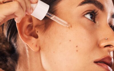 Does Retinol Help with Acne?