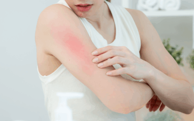 How to combat dry skin and rashes this winter