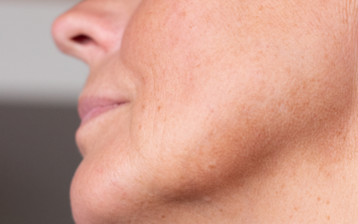 Sun Spots vs Freckles