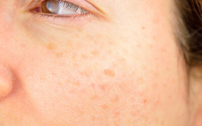 Melasma vs Sun Spots: What’s the Difference?