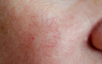 Vascular Skin Lesions Explained: Diagnosis and Laser Treatment Options