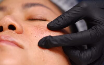 Melasma: Causes, Treatment Options, and How It Differs From Other types of hyperpigmentation